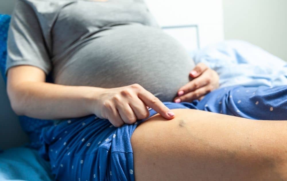 Выступающие вены при беременности